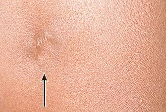 寶寶打過卡介苗的地方紅腫化膿了，該怎么辦？